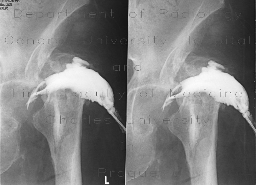 Hip replacement, osteomyelitis, fistula of hip joint