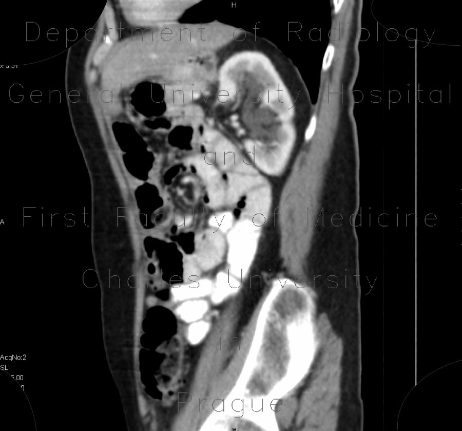 Hydronephrosis, grade II, bilateral, follow-up