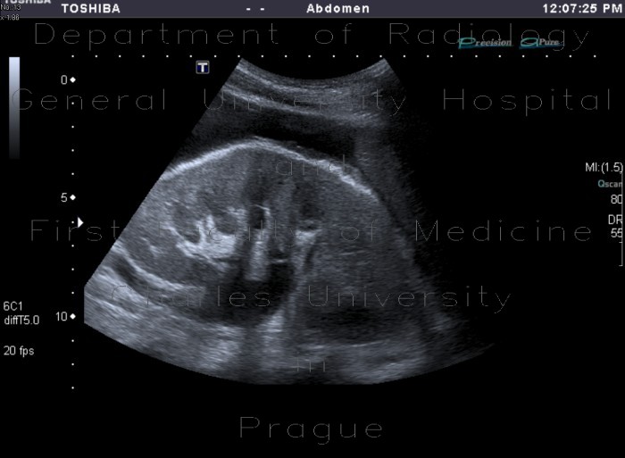 Hydronephrosis, mild edema of kidney