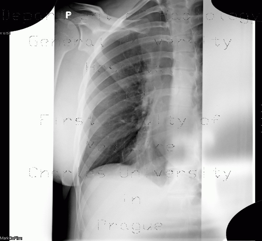 Hydropneumothorax, artifact