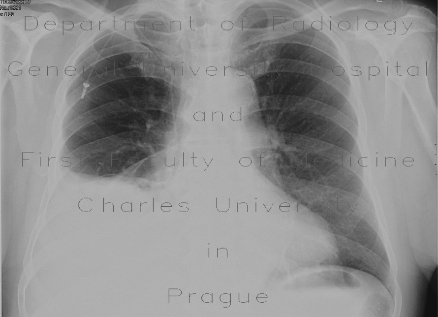Hydrothorax, pleural effusion