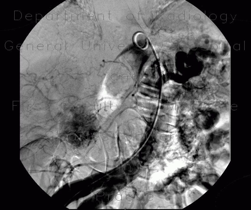 Hypervascular tumour of pancreatic head