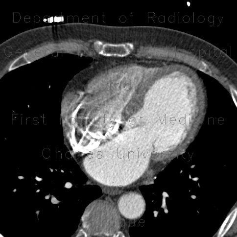 Hypodense subendocardial layer, myocardial infarction