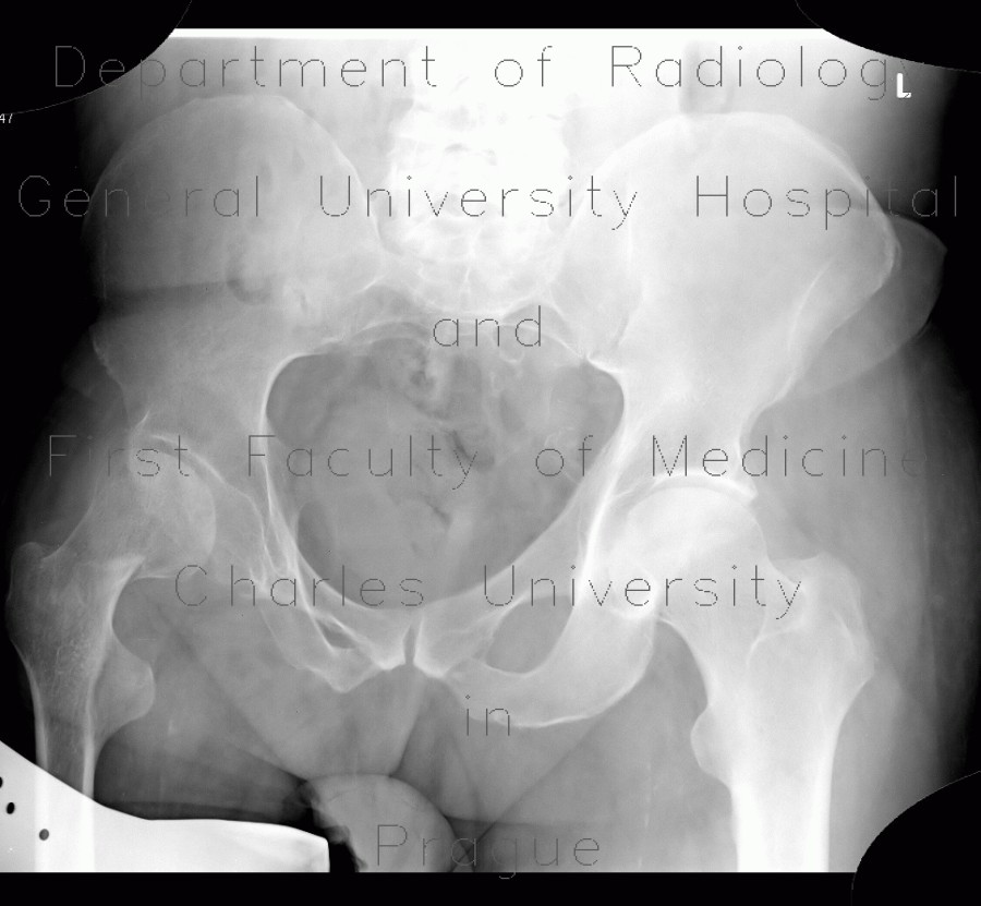 Hypoplasia of pelvis in DMO