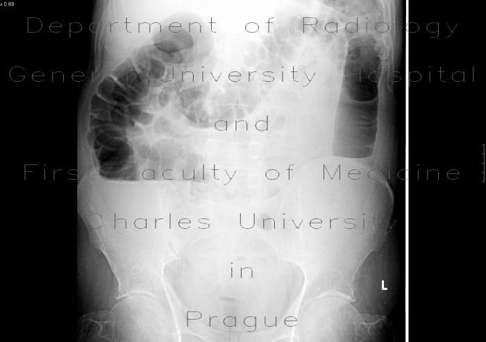 Ileus, large bowel