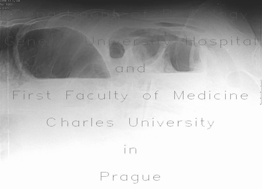 Ileus, pneumoperitoneum, peritonitis
