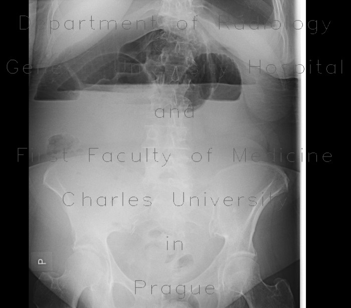 Ileus, small bowel
