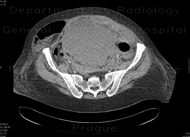 Incarcerated hernia, hematoma of abdominal wall