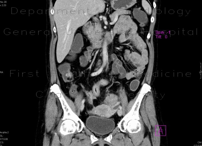 Inflammatory polyp adjacent to ileocecal valve in Crohn's disease