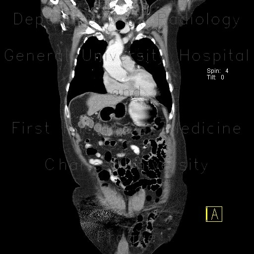 Inguinal hernia