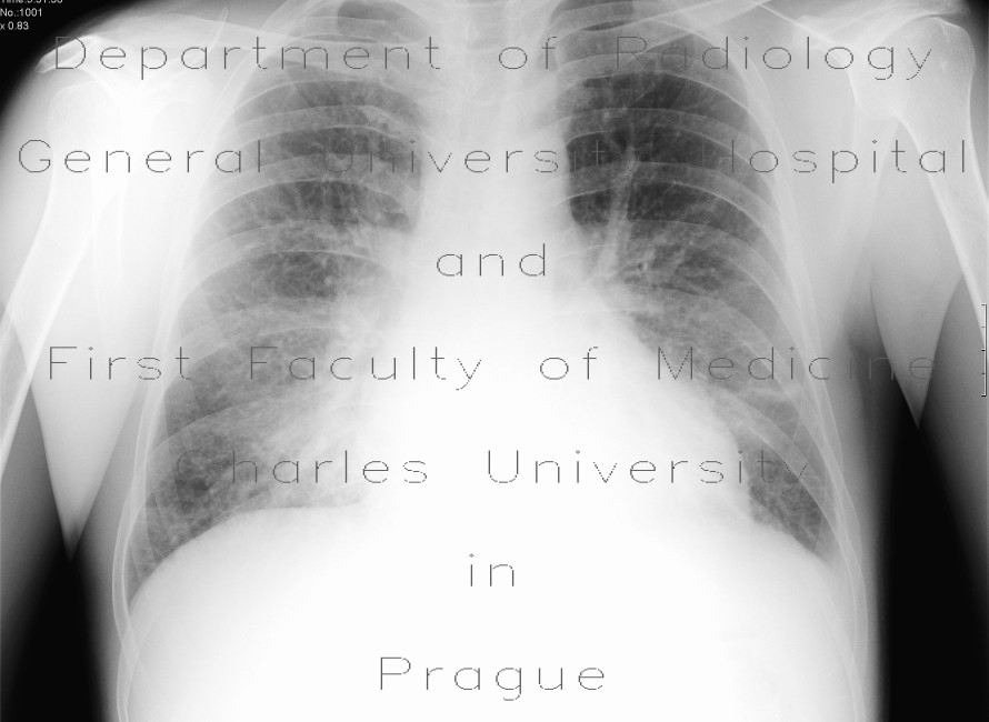Interstitial edema of the lung, Kerley B lines