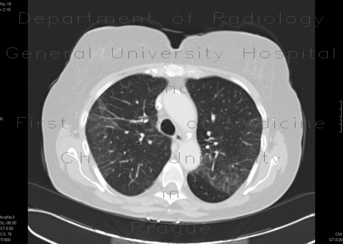 Interstitial pneumonia, HRCT