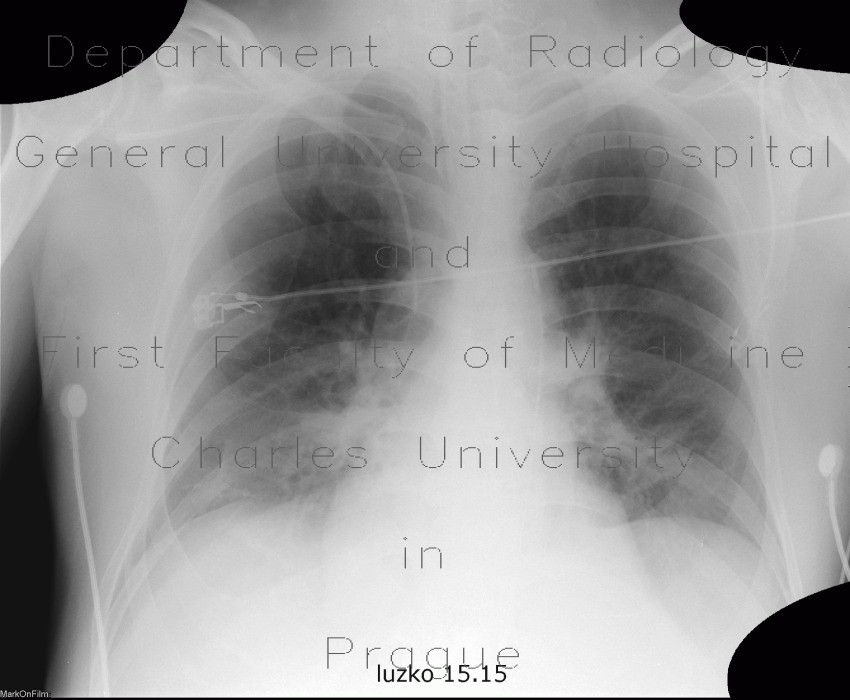 Intraaortic contrapulsation
