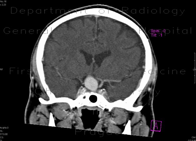 Intracranial aneurysm of the internal carotid artery, ICA
