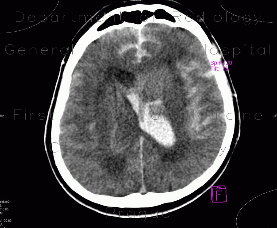 Intracranial aneurysm, subarachonid hemorrhage, hemocephalus