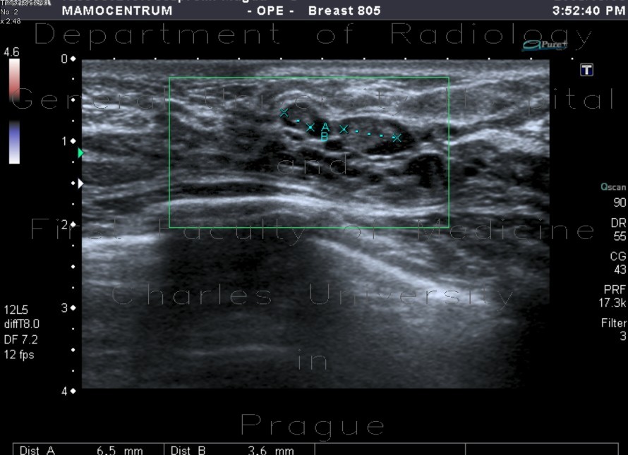 Intraductal papilloma, ectatic ducts