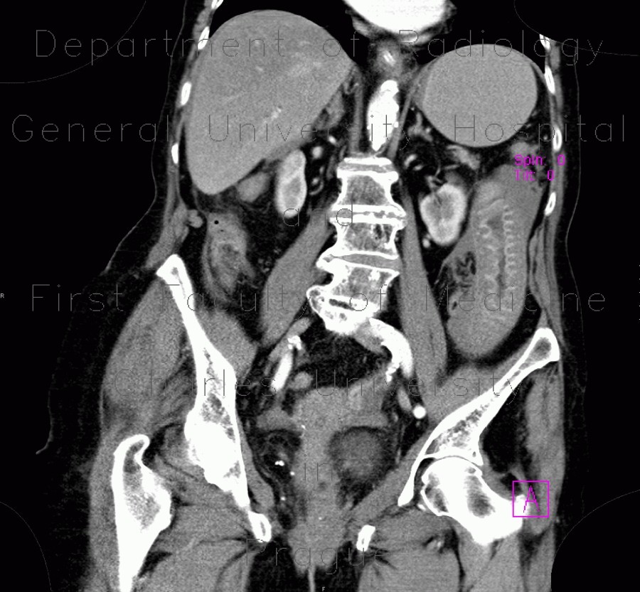 Intramural bleeding in small bowel, bowel wall, intramural hemorrhage