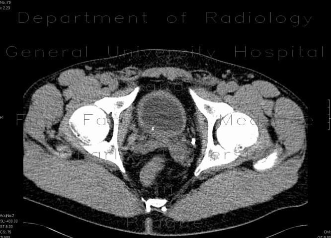 Intramural ureterolithiasis