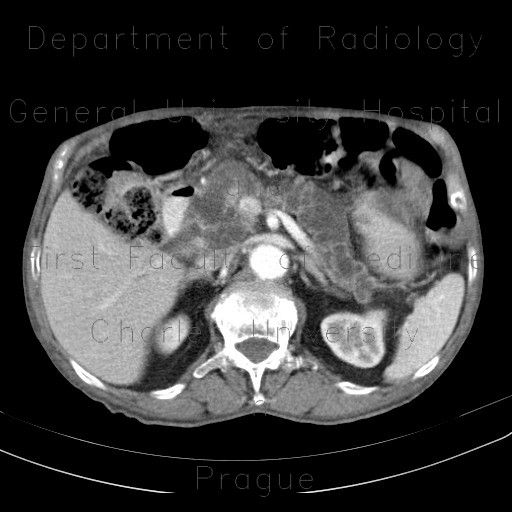 Intrapapillary mucinous neoplasm of pancreas, IPMN, IPMT, main duct type