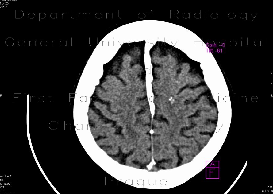 Intraparenchymal calcifications in brain