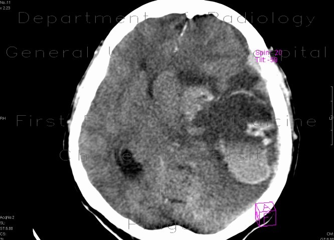 Intraparenchymal hemorrhage