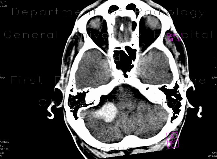 Intraparenchymal hemorrhage into cerebellum