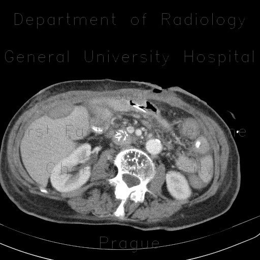 Intraperitoneal hemorrhage, mimic of carcinosis, subcapsular hematoma of the liver
