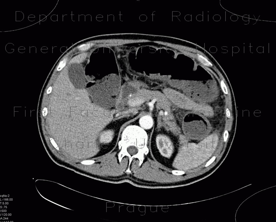 Ischemia of large bowel