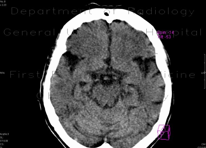 Ischemia, temporal lobe, first CT