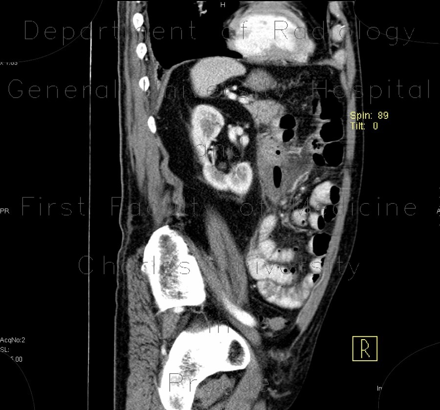 Jejunal diverticulitis, diverticulosis