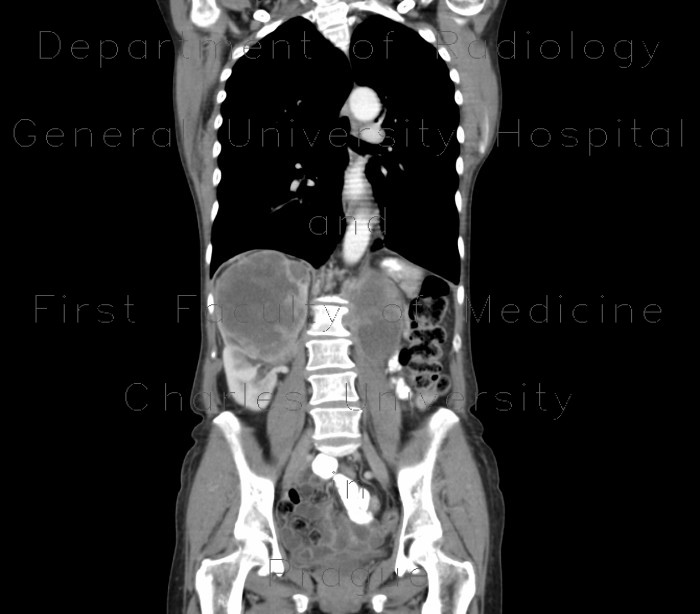 Kidney metastasis of lung carcinoma