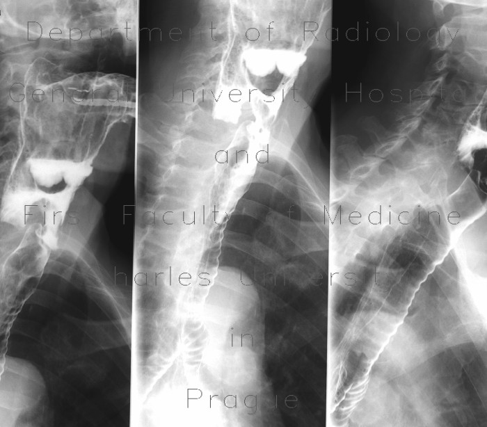 Laryngeal dysphagia, aspiration