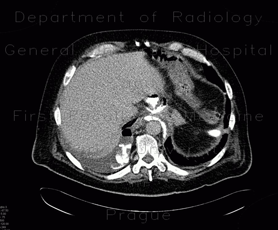 Leak of anastomosis of esophagus in pleural cavity, gastroesophageal anastomosis