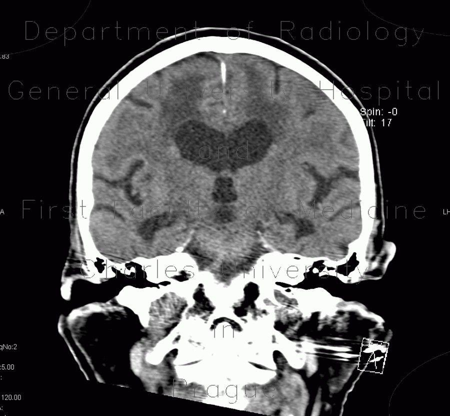 Leukoaraiosis, atherosclerotic encephalopathy, periventricular atrophy, hydrocephalus e vacuo