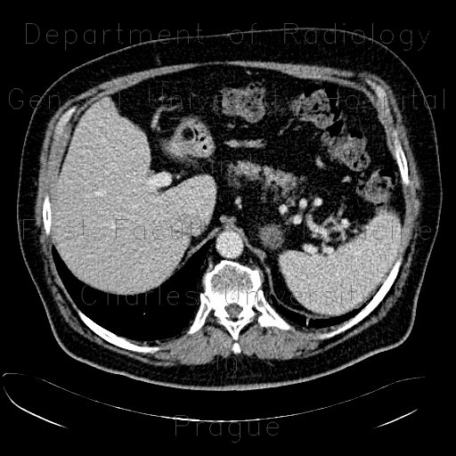 Lipoma in duodenum, small	