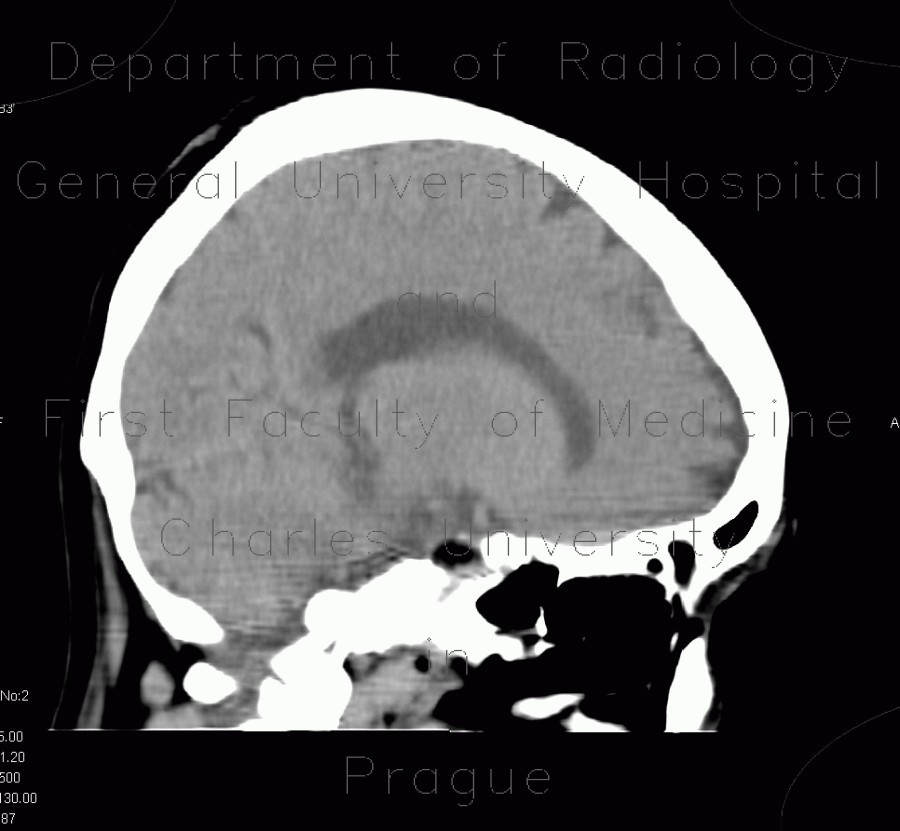 Lipoma, parasellar