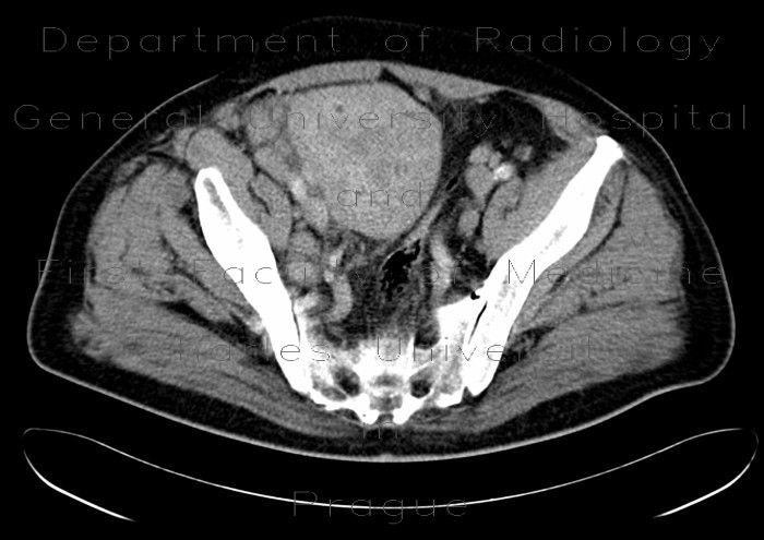 Liponecrotic lymph node, lymphoma