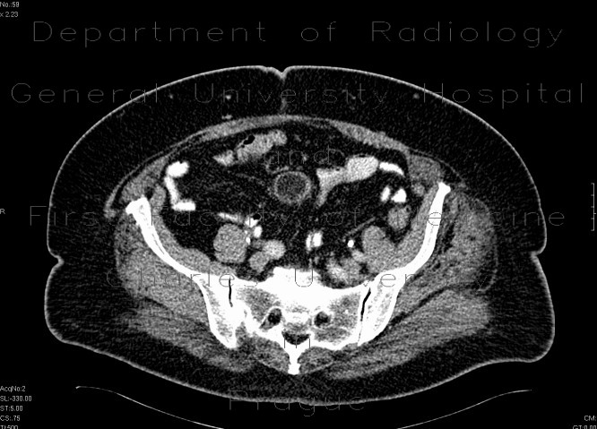 Liposarcoma of mesentery
