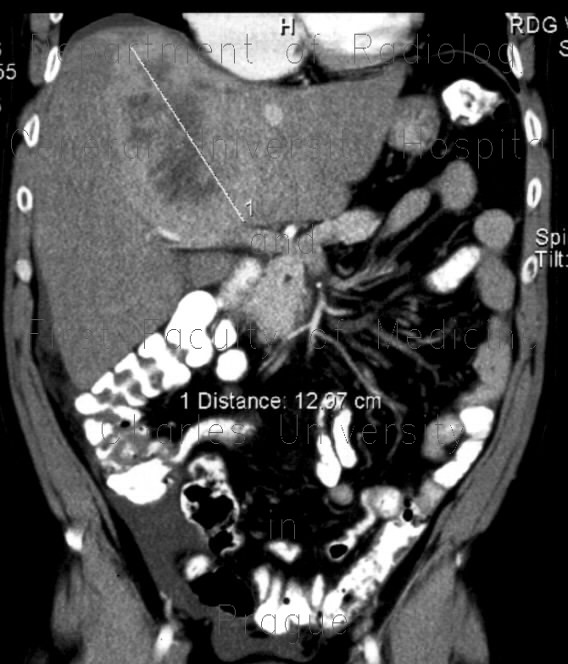Liver carcinoid