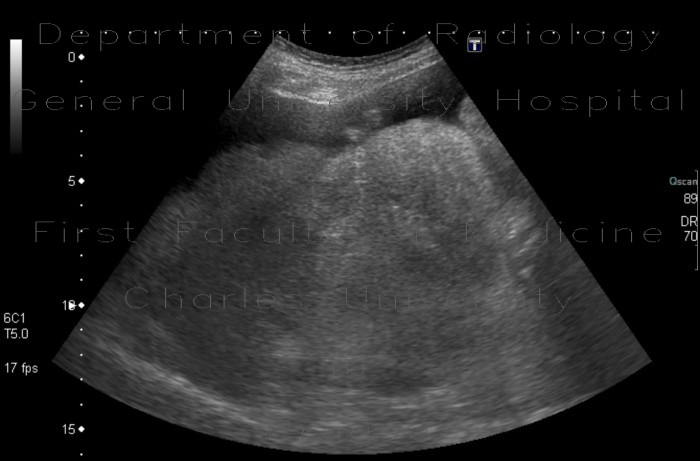 Liver cirrhosis, ascites