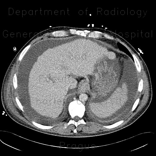 Liver cirrhosis, ascites, portal colonopathy, colopathy