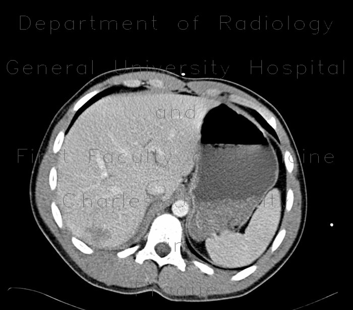 Liver contusion
