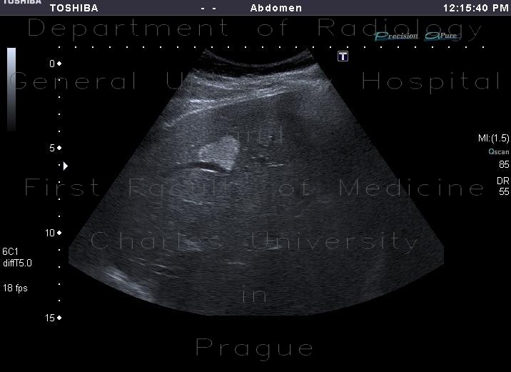 Liver hemangioma