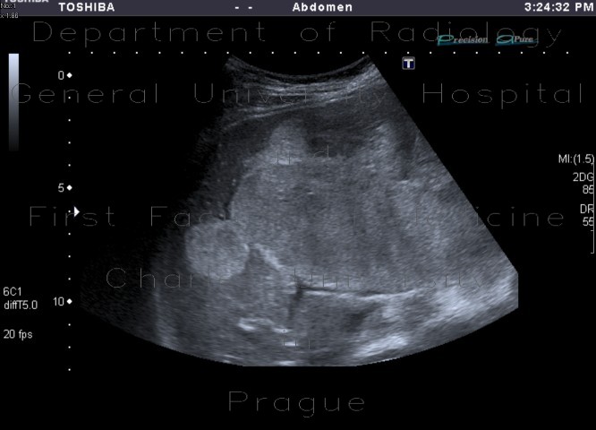 Liver hemangioma, huge