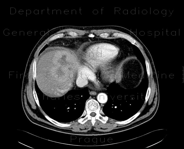 Liver metastases of carcinoid, embolization