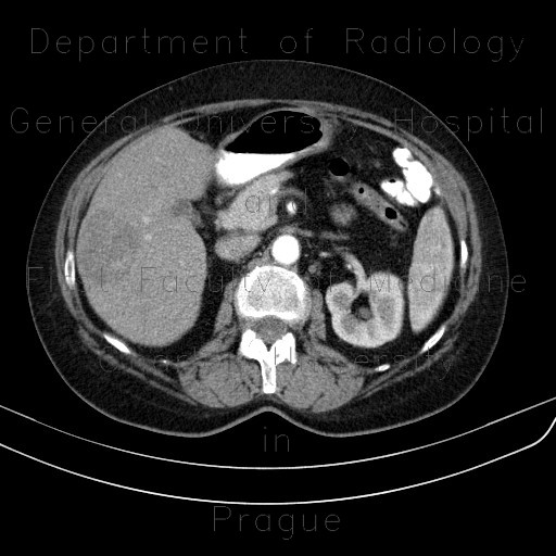 Liver metastasis, RFA, radiofrequency ablation of metastasis, before