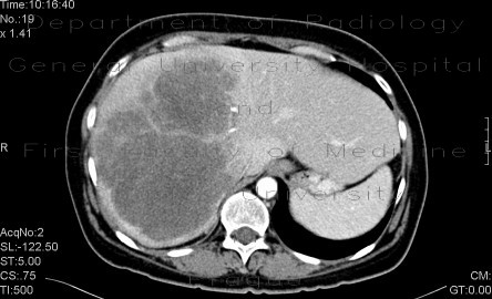 Liver metastasis, huge