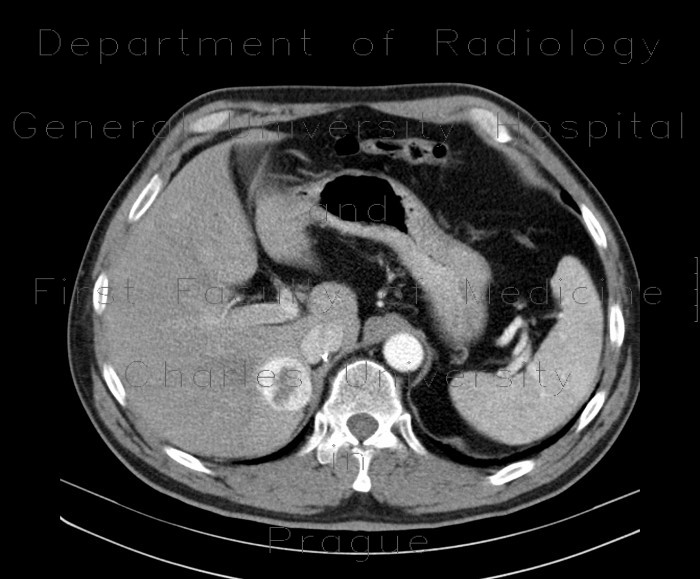 Liver metastasis of renal cell carcinoma, RFA