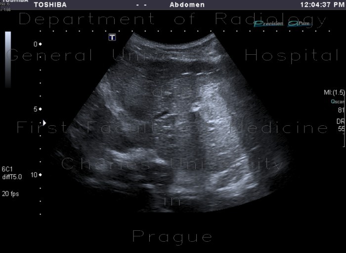 Liver metastasis, peritoneal carcinomatosis