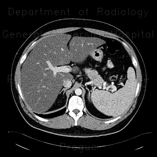Liver steatosis